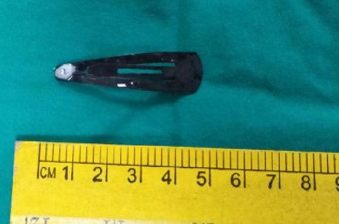 1.5 Yr Old Boy Swallowed 4cm Tic Tac Hair Pin, Removed At Wadia Hospital