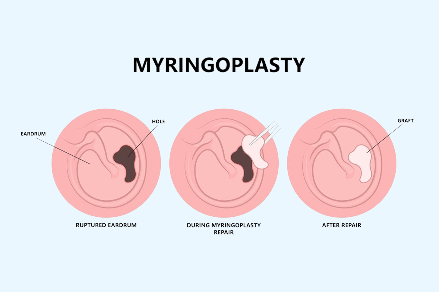 Explore expert Myringoplasty, Tympanoplasty, and Mastoidectomy surgeries at Earth ENT Clinic in Mumbai. Our specialized procedures offer advanced treatment for ear conditions using innovative techniques. Trust our skilled professionals to deliver personalized care and comprehensive solutions, ensuring optimal outcomes for your ear health and overall well-being.