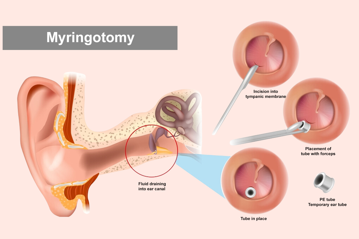 Discover expert Myringotomy with Grommet Insertion surgery at Earth ENT Clinic in Mumbai. Our specialized procedure provides effective treatment for ear conditions using advanced techniques. Trust our skilled professionals to deliver personalized care and innovative solutions, ensuring optimal outcomes for your ear health and well-being.