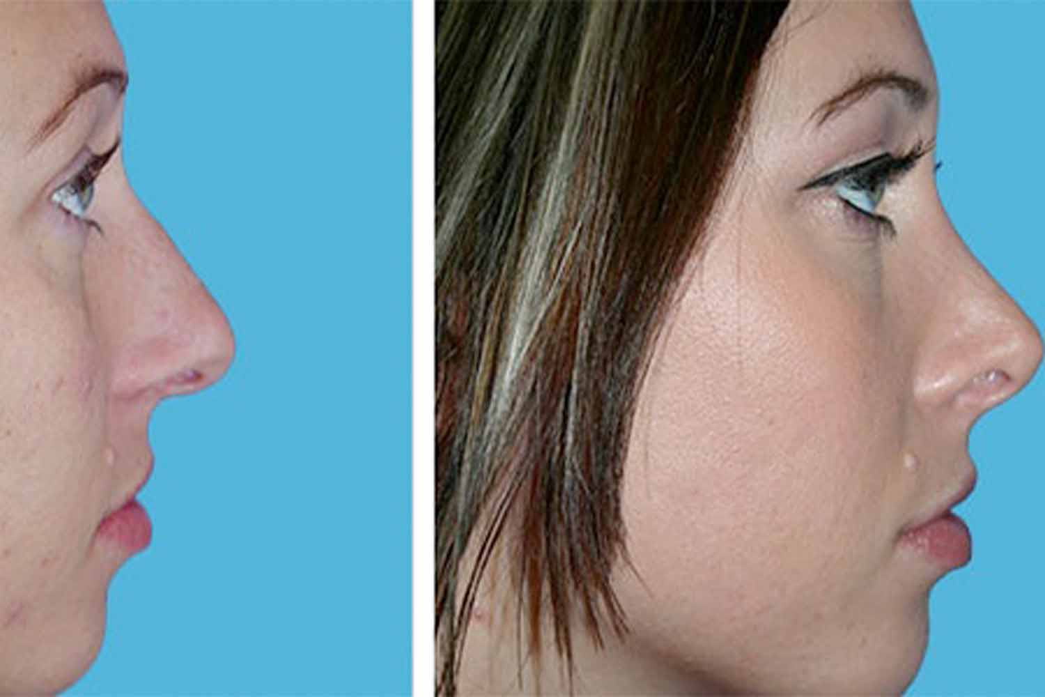 Earth ENT Clinic provides best Septoplasty Surgery in Sion Mumbai, ensuring effective nasal correction by ENT Surgeons Dr. Balagopal Kurup & Dr. Srinidhi Ravi.